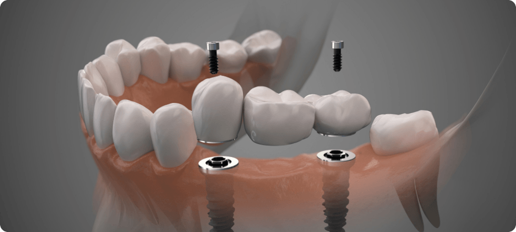 Chirurgie orale & l’implantologie